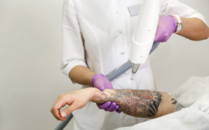 Tattoo Removal with Laser – Procedure, Sessions & Results
